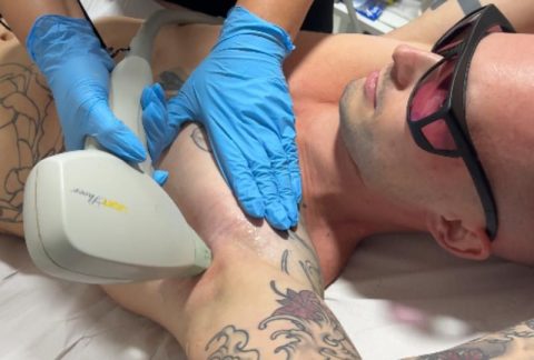 Laser Hair Removal