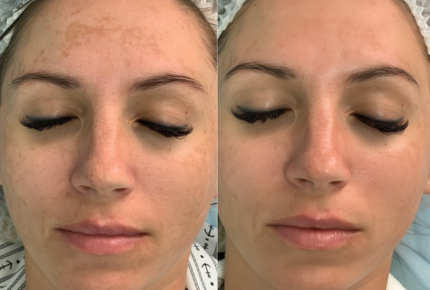 Laser Pigmentation Removal